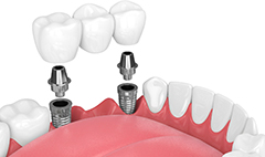 dental bridge being placed onto two dental implant posts 