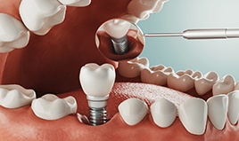 Digital diagram showing dental implant surgery in Wilton Manors