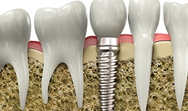 Diagram of dental implant in Wilton Manors during osseointegration 