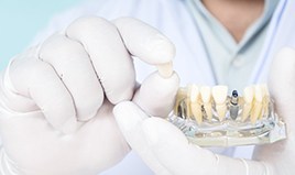  Wilton Manors implant dentist holding model dental implant and restoration 