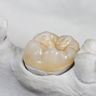 natural looking dental crown