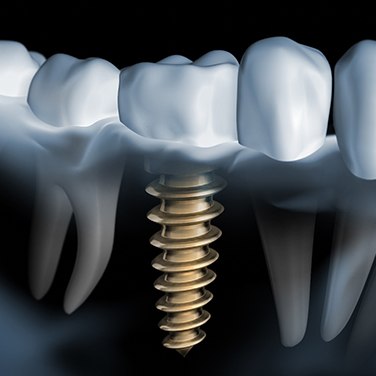 X-ray of a patient with dental implants in Wilton Manors 