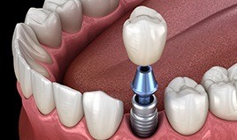 dental crown being placed on top of a single implant post 