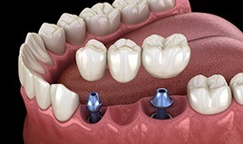 dental bridge being placed onto two implants 