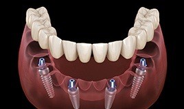 full implant denture being placed 