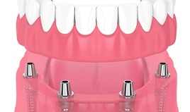 3D illustration of an implant denture on lower jaw