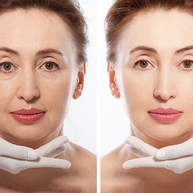  Before and after a woman receives dermal fillers