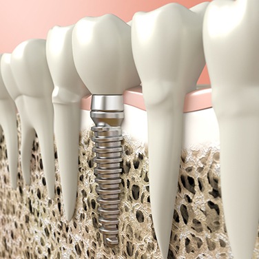 A diagram of a dental implant.