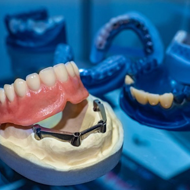 Model of implant denture