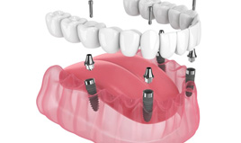 Illustration of implant dentures