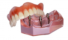 Model of removable implant denture