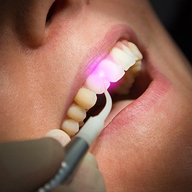 Laser behind teeth
