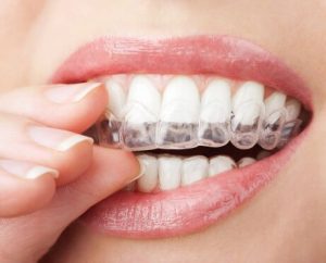 Invisalign aligners in Fort Lauderdale straighten crooked smiles.