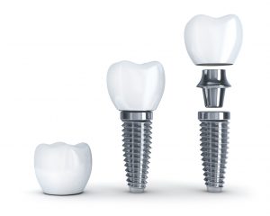 Dental implants in Fort Lauderdale look and feel natural.