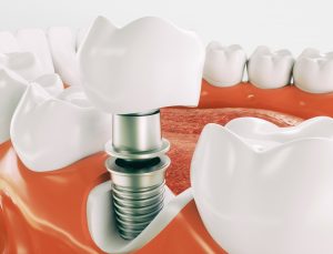 dental implant illustration