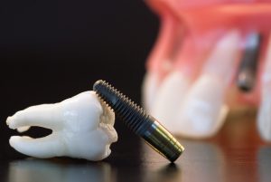 tooth and implant