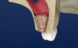 Model of bone graft procedure